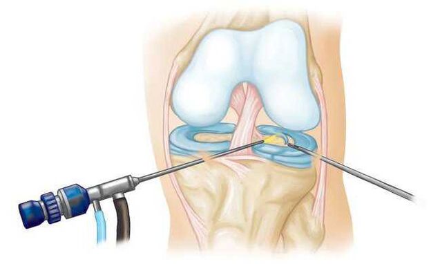 At the last stage of development, arthrosis is treated surgically