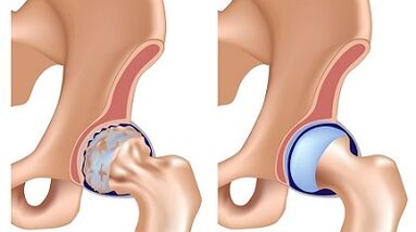 Symptoms of arthrosis of the hip joint