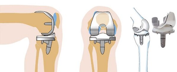 Endoprosthetics operation of the knee joint for arthrosis