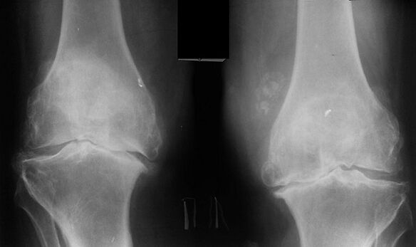 X -ray as a way of diagnosing knee joint arthrosis