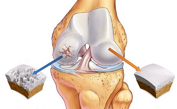 norms and deviations for knee joint arthrosis