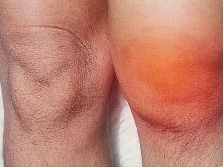 Inflammation of the knee joints affected by arthritis