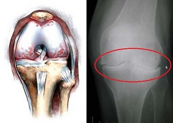 Knee joint deformation for arthrosis