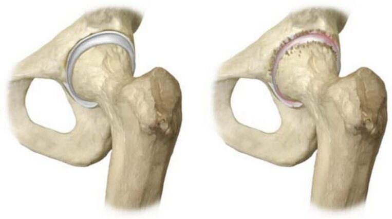 healthy hip joints and necrosis of the head as the cause of pain