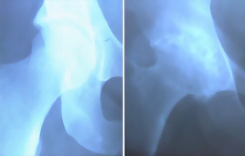 image of knee joint arthrosis