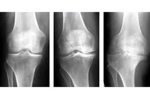 degree of joint arthrosis on x-ray