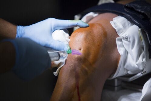 Injections into the knee joint for arthrosis